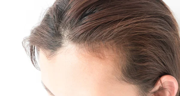 Mujer grave problema de pérdida de cabello para el cuidado de la salud champú y concepto de producto de belleza — Foto de Stock