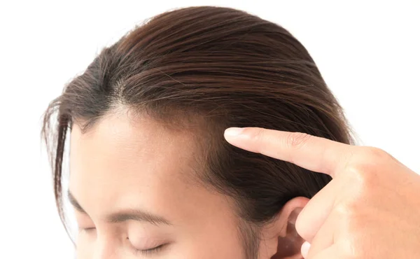 Nő súlyos hajhullás probléma egészségügyi sampon és szépségápolási termék koncepció — Stock Fotó
