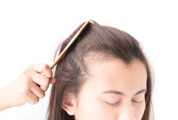 Mujer grave problema de pérdida de cabello para el cuidado de la salud champú y concepto de producto de belleza —  Fotos de Stock