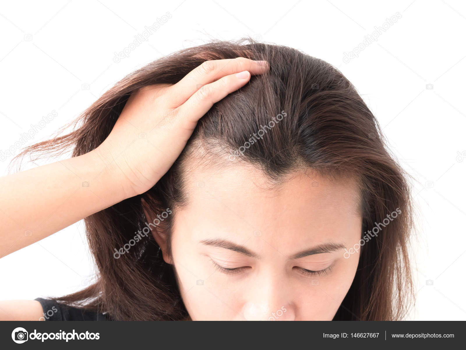 Mujer grave problema de pérdida de cabello para el cuidado