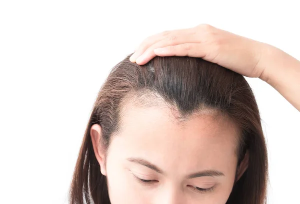 Mujer grave problema de pérdida de cabello para el cuidado de la salud champú y concepto de producto de belleza — Foto de Stock