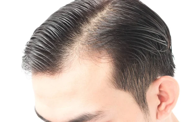 Молодий чоловік серйозна проблема випадіння волосся для охорони здоров'я шампунь і концепція косметичного продукту — стокове фото