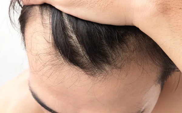 Närbild ung man allvarliga hår förlust problem för hälso-och schampo och skönhet produktkoncept — Stockfoto