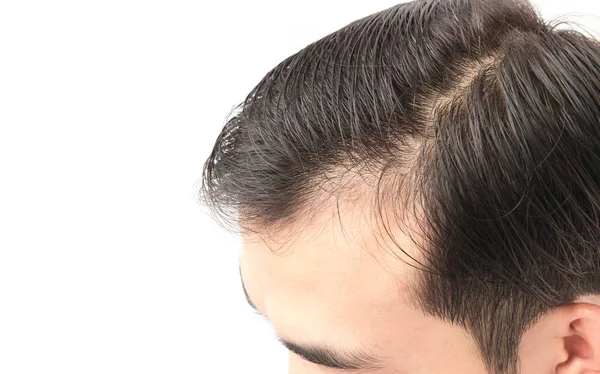 Closeup young man serious hair loss problem for health care sham — Stock Photo, Image