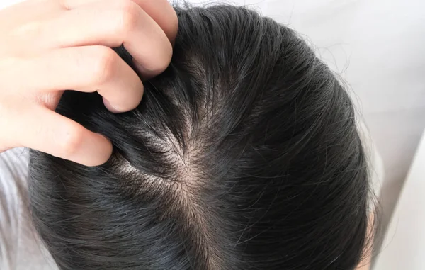 Closeup woman hand itchy scalp, Hair care concept — Stock Photo, Image