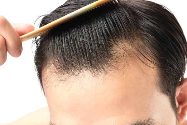 Ciddi saç dökülmesi problemi sağlık şampuan ve güzellik ürün kavramı için genç adam — Stok fotoğraf