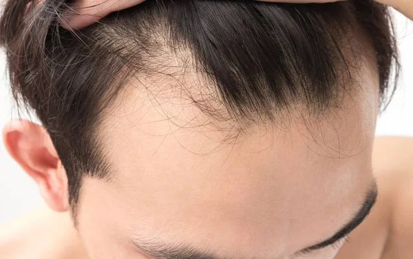 El hombre joven preocupa el problema de pérdida de cabello para el champú de atención médica y ser — Foto de Stock