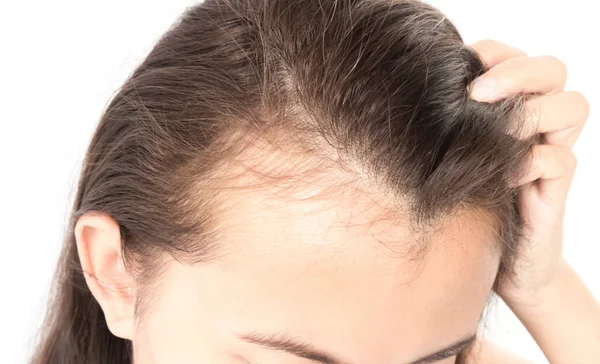 Mujer grave problema de pérdida de cabello para el cuidado de la salud champú y concepto de producto de belleza —  Fotos de Stock