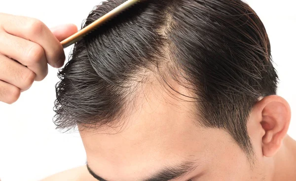 Ciddi saç dökülmesi problemi sağlık şampuan ve güzellik ürün kavramı için genç adam — Stok fotoğraf