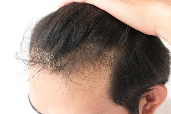 Homem jovem grave problema de perda de cabelo para cuidados de saúde shampoo e conceito de produto de beleza — Fotografia de Stock