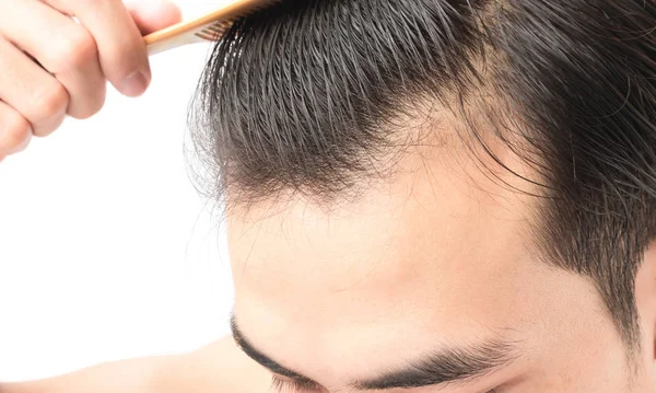 Junger Mann ernstes Haarausfall-Problem für Gesundheitsshampoo und Beauty-Produktkonzept — Stockfoto