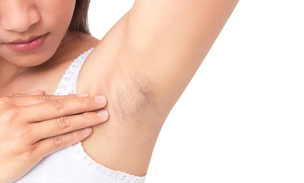 Kvinner får problemer med svart armhule på hvit bakgrunn for hudpleie og – stockfoto