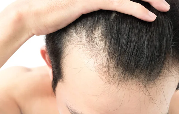 Homem jovem grave problema de perda de cabelo para cuidados de saúde shampoo e conceito de produto de beleza — Fotografia de Stock