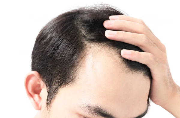 Young man serious hair loss problem for health care shampoo and beauty product concept — Stock Photo, Image