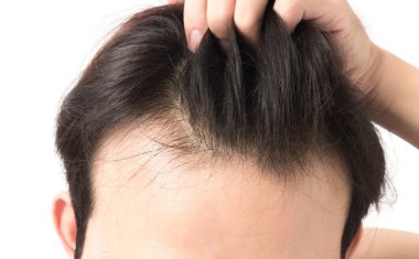 Ciddi saç dökülmesi problemi sağlık şampuan ve güzellik ürün kavramı için genç adam