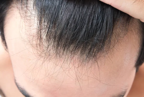 Молодой человек серьезная проблема выпадения волос для здравоохранения шампунь и косметический продукт концепции — стоковое фото