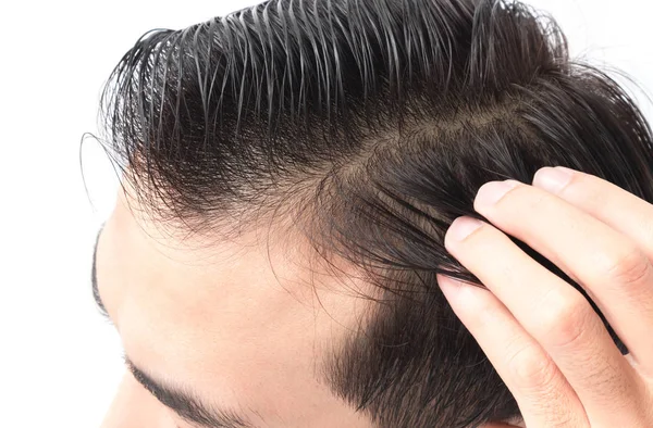 Anak muda serius kehilangan rambut masalah untuk kesehatan sampo dan konsep produk kecantikan — Stok Foto