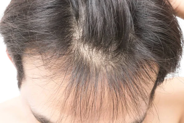 Giovane uomo grave problema di perdita dei capelli per shampoo di assistenza sanitaria e concetto di prodotto di bellezza — Foto Stock