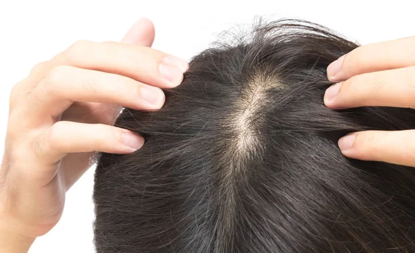 Молодой человек серьезная проблема выпадения волос для здравоохранения шампунь и косметический продукт концепции — стоковое фото