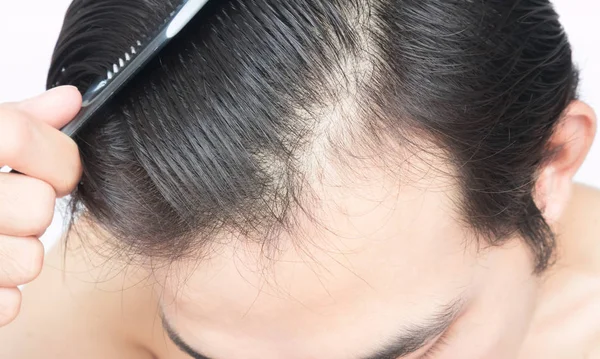 Mladý muž vážné vlasy ztráta problém pro zdravotní péče šampon a koncepce produktu krásy — Stock fotografie