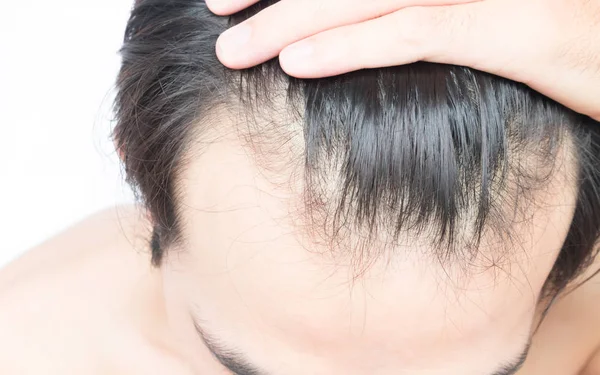 Homem jovem grave problema de perda de cabelo para cuidados de saúde shampoo e conceito de produto de beleza — Fotografia de Stock