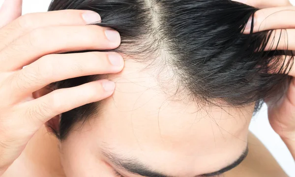 Молода людина серйозна проблема випадіння волосся для шампунь охорони здоров'я і — стокове фото
