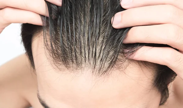 Homem jovem grave problema de perda de cabelo para cuidados de saúde shampoo e conceito de produto de beleza — Fotografia de Stock