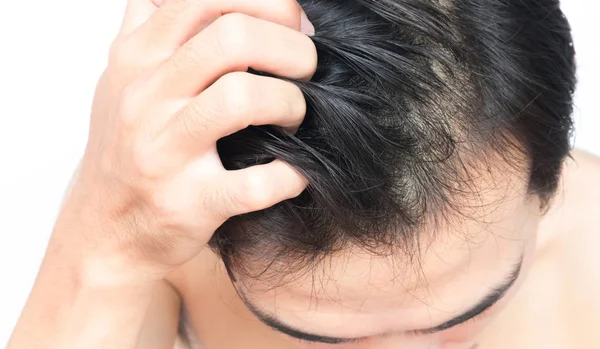 Primer plano hombre mano picazón cuero cabelludo, concepto de cuidado del cabello — Foto de Stock