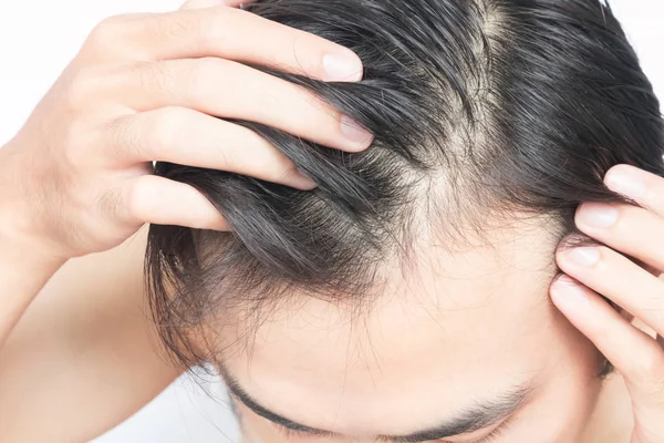 Молодой человек серьезная проблема выпадения волос для шампуня здравоохранения и — стоковое фото