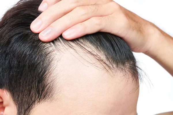 Молодой человек серьезная проблема выпадения волос для шампуня здравоохранения и — стоковое фото