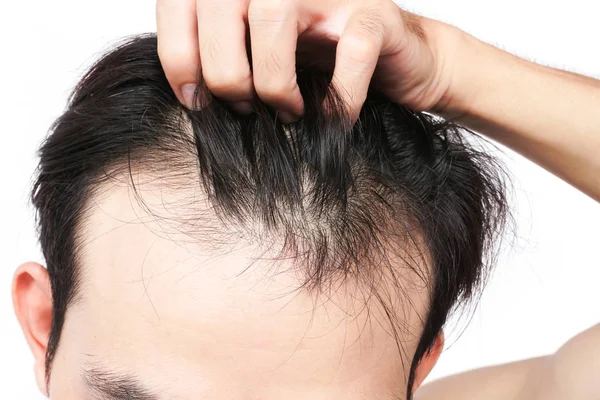 Young man serious hair loss problem for health care shampoo and Stock Picture