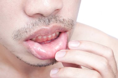 Tatlı dudaklar adam sorun sağlık hizmetlerinin, Herpes simpleks