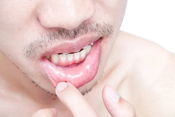 Close up of lips man problem health care, Herpes simplex — стоковое фото