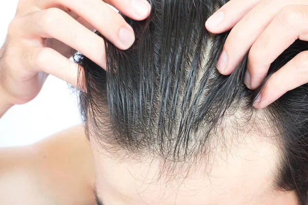 Giovane uomo grave problema di perdita dei capelli per l'assistenza sanitaria concetto di prodotto medico e shampoo — Foto Stock