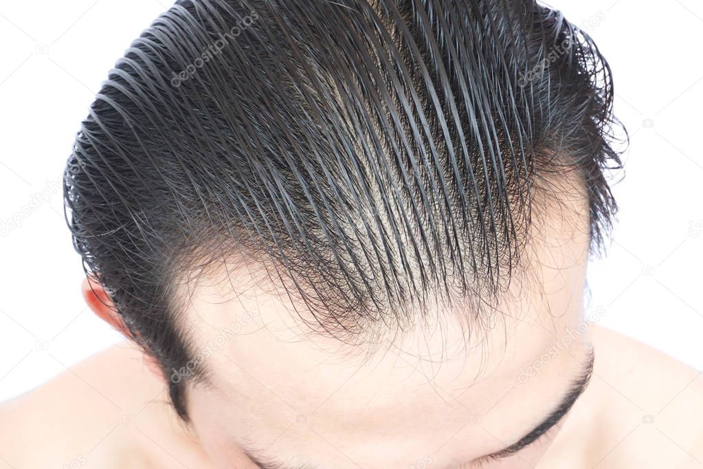 Young man serious hair loss problem for health care medical and shampoo product concept