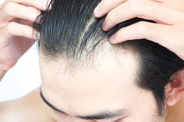 Joven hombre serio problema de pérdida de cabello para el cuidado de la salud médico y champú concepto de producto — Foto de Stock