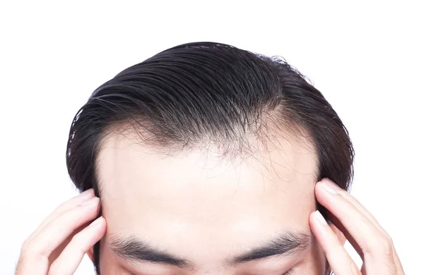 Joven hombre serio problema de pérdida de cabello para el cuidado de la salud médico y champú concepto de producto — Foto de Stock