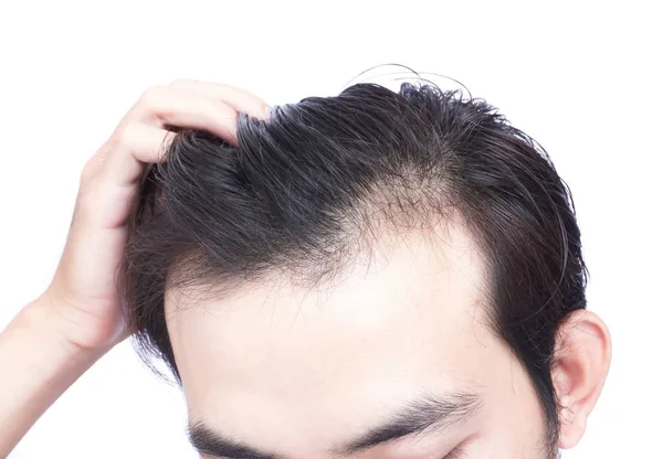 Genç adam sağlık hizmetleri tıbbi ve şampuan ürün konsepti için ciddi saç kaybı sorunu — Stok fotoğraf