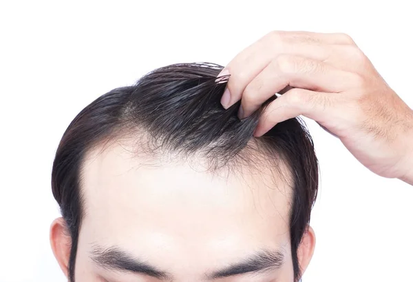 Giovane uomo grave problema di perdita dei capelli per l'assistenza sanitaria concetto di prodotto medico e shampoo — Foto Stock