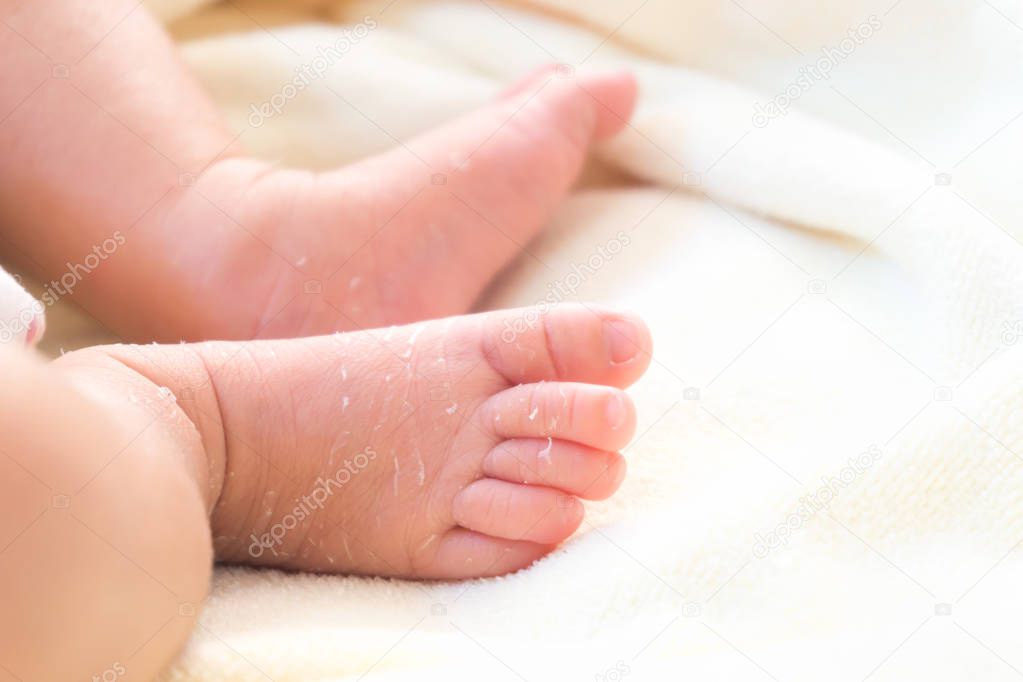 Closeup legs of newborn with peeling skin on white cloth, health care and medical concept, selective focus