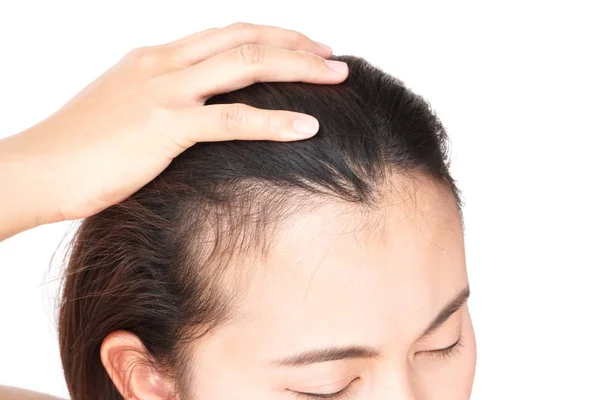 Mujer grave problema de pérdida de cabello para el cuidado de la salud champú y beau —  Fotos de Stock