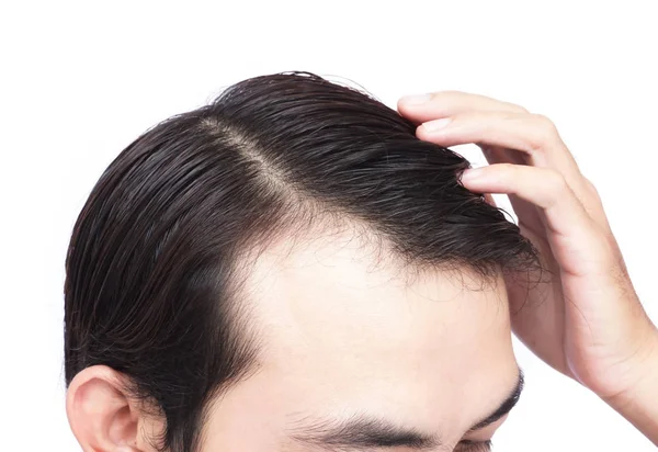 Joven hombre serio problema de pérdida de cabello para el cuidado de la salud médico y champú concepto de producto —  Fotos de Stock
