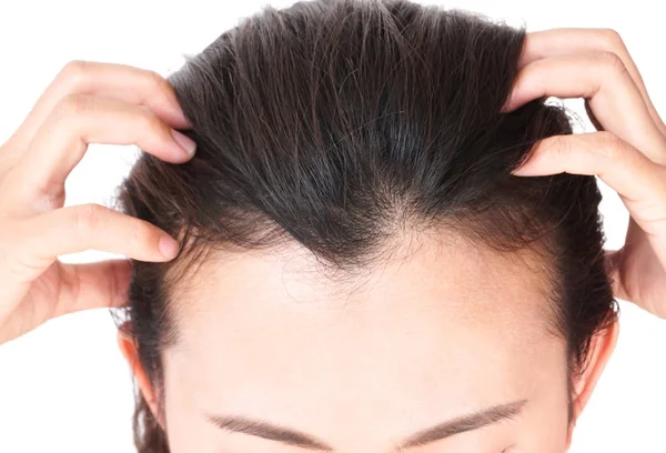 Sağlık hizmetleri şampuanı ve güzellik ürünleri konsepti için kadın ciddi saç kaybı sorunu — Stok fotoğraf