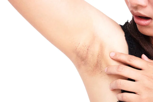 Frauen Problem schwarze Achselhöhle auf weißem Hintergrund für Hautpflege und Schönheitskonzept — Stockfoto