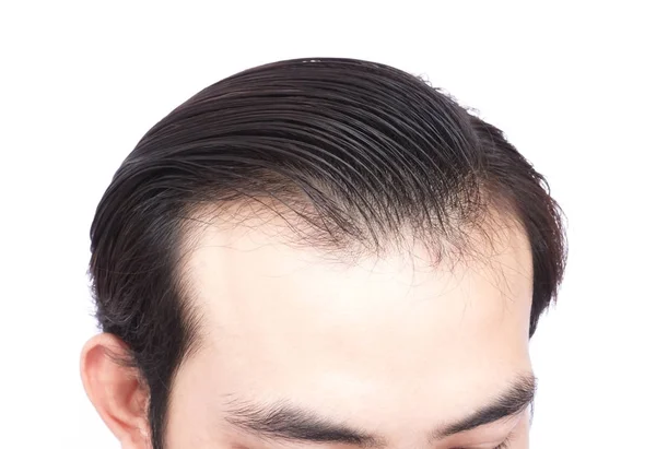 Joven hombre serio problema de pérdida de cabello para el cuidado de la salud médico y champú concepto de producto — Foto de Stock