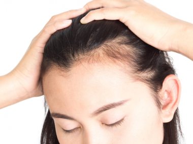 Sağlık hizmetleri şampuanı ve güzellik ürünleri konsepti için kadın ciddi saç kaybı sorunu