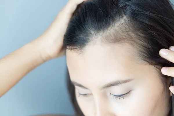 Mulher grave problema de perda de cabelo para cuidados de saúde shampoo e conceito de produto de beleza, foco seletivo — Fotografia de Stock