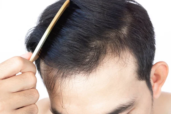 Young man serious hair loss problem for health care medical and shampoo product concept, selective focus — Stock Photo, Image