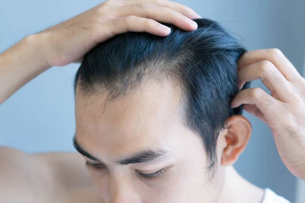 Giovane uomo grave problema di perdita dei capelli per l'assistenza sanitaria concetto di prodotto medico e shampoo, messa a fuoco selettiva — Foto Stock