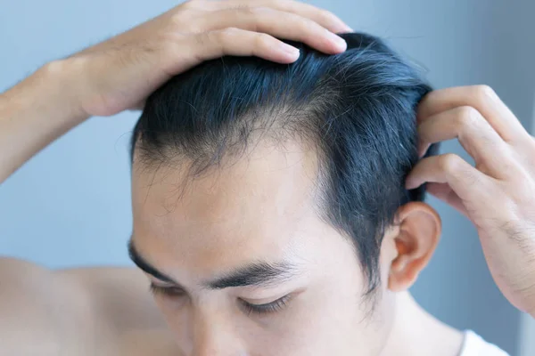 Junger Mann ernstes Haarausfall-Problem für Gesundheitswesen medizinisches und Shampoo-Produktkonzept, selektiver Fokus — Stockfoto